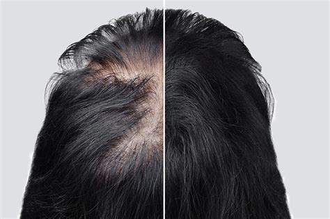 Stress-Induced Hair Loss: It Can Happen - UHealth Collective