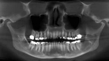 Odontogenic Keratocyst Pathology: Definition, Epidemiology, Etiology