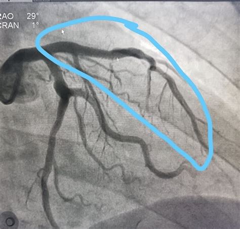 CATETERISMO CARDÍACO: TUDO O QUE VOCÊ GOSTARIA DE SABER — Cardio DF – Cardiologia e saúde ...