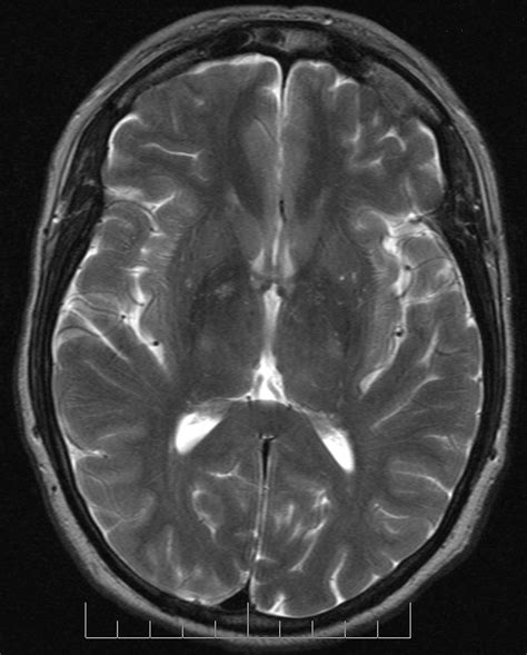 Concussion Brain MRI's, CT scans, and EEG - Concussion Clinic