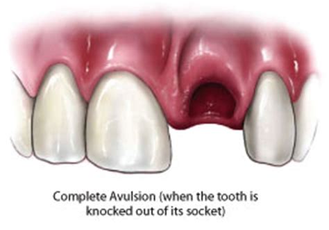 Tooth Avulsion; Dislocation, Tooth; Tooth Luxation; Avulsed Tooth