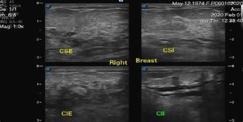 Ultrasound findings of the left breast shown a skin thickening, with... | Download Scientific ...