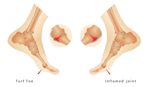 Turf Toe Exercises: Rehabbing the MTP Joint - Inspire US