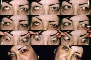 Left inferior oblique palsy - American Academy of Ophthalmology