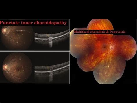 Punctate inner choroidopathy (PIC) & Multifocal choroiditis and panuveitis (MFC) #KanskiSeries ...