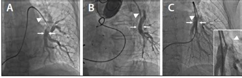 Cardiac Interventions Today - How to Implant the CardioMEMS Heart ...