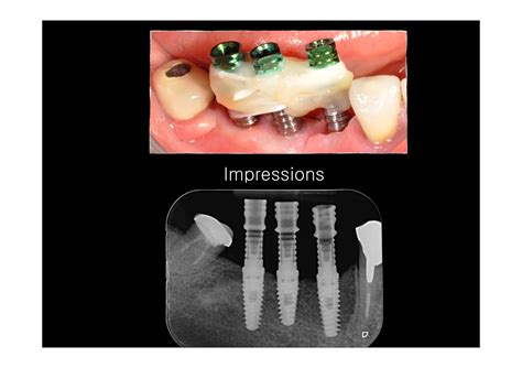 Cosmetic Dentistry Implants - Dental Implants : Dental Implants