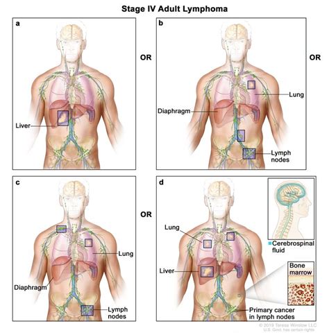 Hodgkin Lymphoma Treatment - NCI