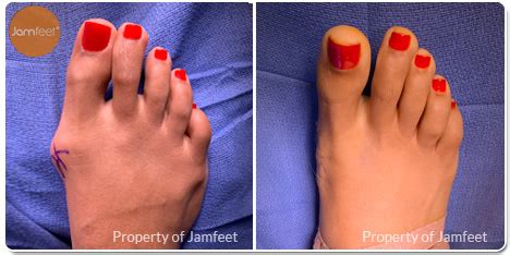 Before & After Bunion Surgery Photo Gallery | Los Angeles Foot Doctor | Beverly Hills (2023)