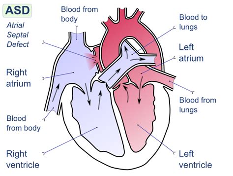 Left-to-right shunt - wikidoc