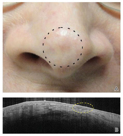 Basal Cell Carcinoma Nose