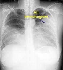 An air bronchogram appears when an infiltrate surrounds a peripheral bronchi, and … | Acute ...