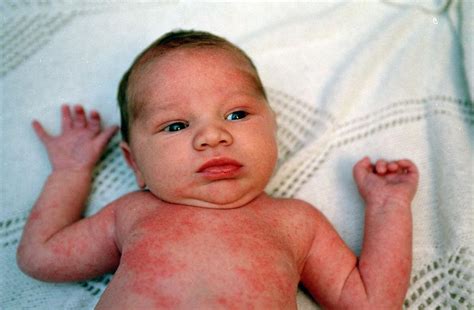 Baby Rash Pictures, Causes, Treatments - Mommyhood101