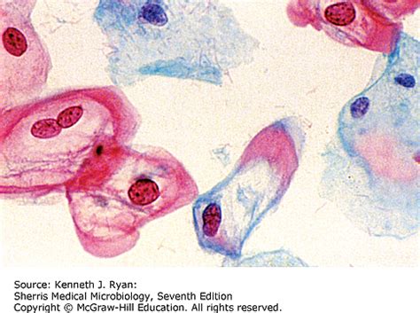 Abnormal Pap Smear | AccessMedicine Network