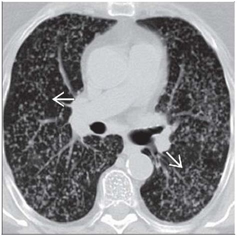 Tuberculosis, Miliary | Radiology Key