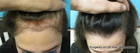 US Hair Transplant» Blog Archive » Women Hair Loss Treatments