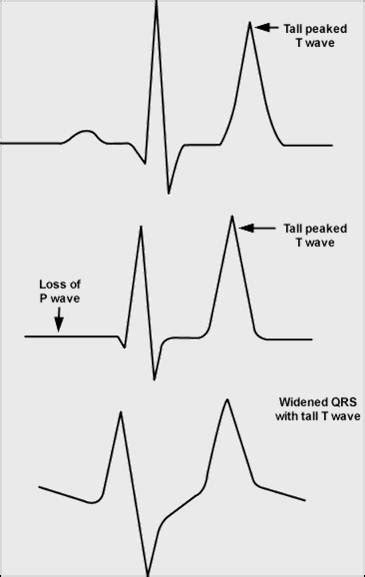 Peaked T waves - wikidoc