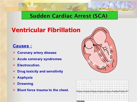 Sudden Cardiac Arrest