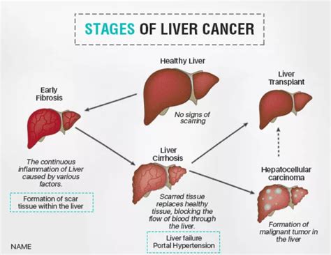 Liver cancer Treatment | Risk, symptoms and causes - AILBS India