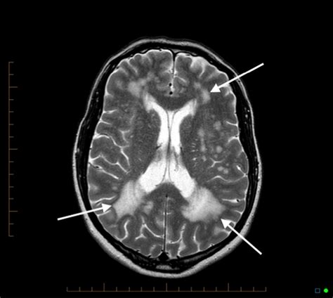 Incidental extensive periventricular white matter changes | Download Scientific Diagram