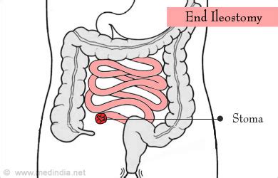 Ileostomy - Types, Tests Required, Benefits and Risks