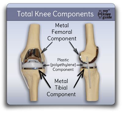 The Knee Prosthesis: The different types