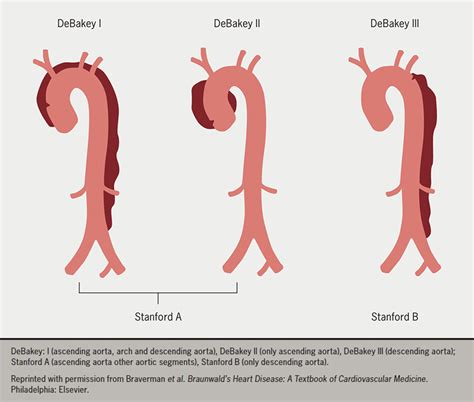 Thoracic Aortic Aneurysm Classification