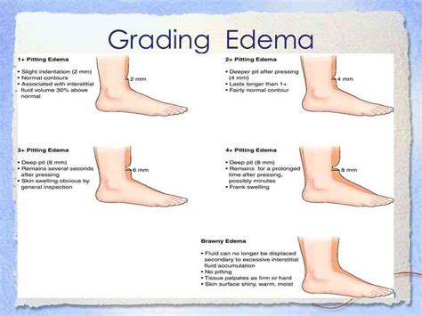 Edema Rating Scale