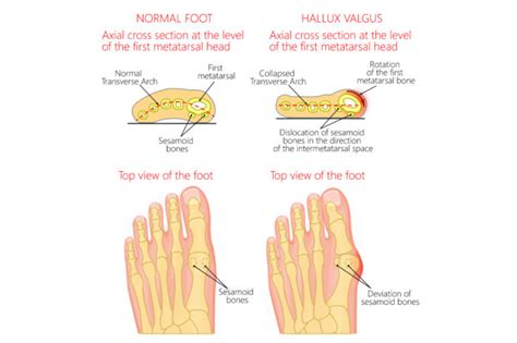 Hallus Rigidus v. Hallux Valgus - How do they differ?