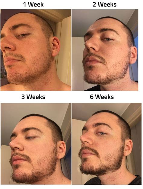 Minoxidil Before And After Beard Result - How Effective Is Minoxidil For Hair Growth Quora ...