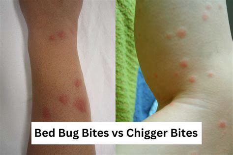 Chigger Bites vs. Bed Bug Bites: How to Tell Them Apart