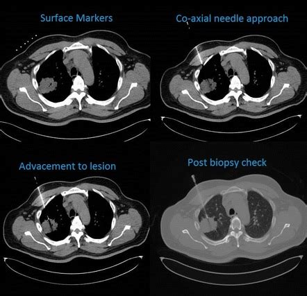 CT guided lung biopsy - deep transpectoral | Radiology Case | Radiopaedia.org