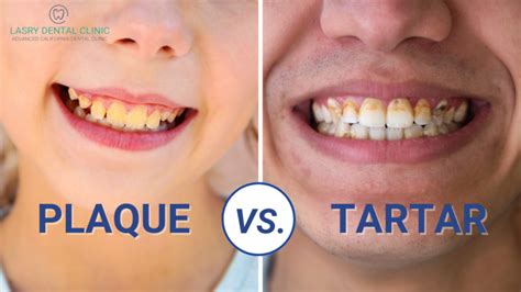 Plaque vs. Tartar and How To Remove Them At Home