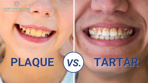 Plaque vs. Tartar and How To Remove Them At Home