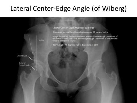 Adult hip dysplasia