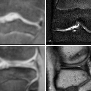 MRI images of the discoid meniscus of the right knee in the 13-year-old ...