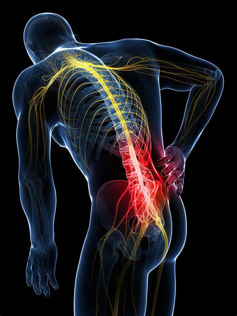 Pinched Nerve, Nerve compression: Symptoms & Treatment