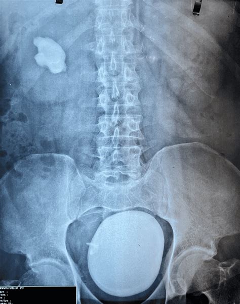 KUB x-ray demonstrating the stone KUB: kidney, ureter, and bladder ...