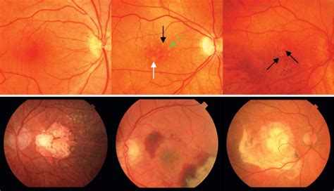 Top left: normal macula. Top center: macula with intermediate AMD ...