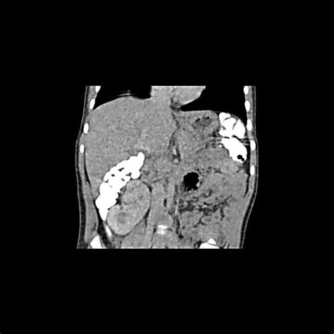 Right kidney malrotation | Radiology Case contributed by Dr Arthur ...