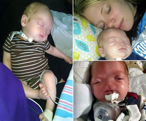 [PIC] Baby Born Without Nose: Eli Thompson Suffers From Rare ...