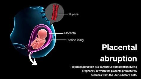 Placental Abruption Settlements and Verdicts | Baltimore, Maryland Birth Injury Attorney