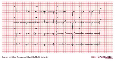 McGill Case 211 - ECGpedia