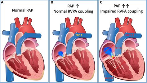 Transcatheter Edge-to-edge Repair (TEER) Of The Tricuspid, 50% OFF