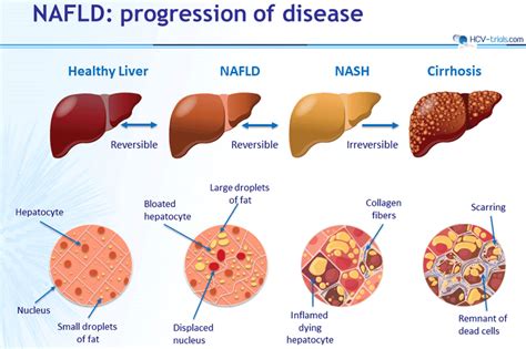 Non-Alcoholic Fatty Liver Disease: Emerging Concepts in Pathogenesis - CME INDIA