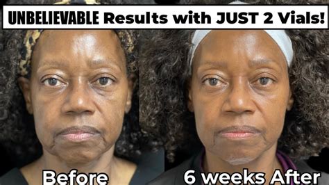 Incredible Sculptra Before and After in Only 6 Weeks! - YouTube