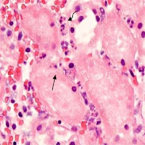 Renal parenchyma with high magnification view of tubules showing loss ...