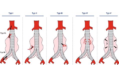 Cureus | Type III Endoleak Leading to Aortic Rupture After Endovascular ...