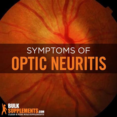 Optic Neuritis: Symptoms, Causes & Treatment