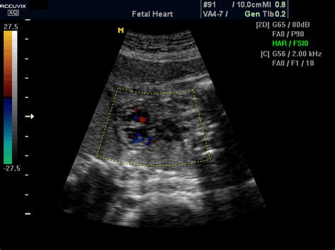 Ultrasound images • Fetal heart - RVOT, color doppler, echogramm №393